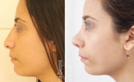 Фото до и после устранения посттравматической деформации носа