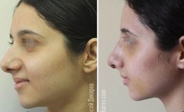Фото до и после имиджевой риносептопластики, остеотомии костей носа