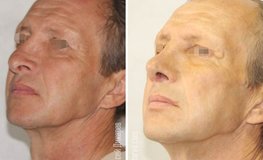 Фото до и после устранения посттравматической панфациальной травмы носа