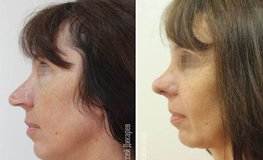 Фото до и после удаления посттравматической панфациальной травмы носа