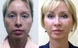 Фото до и после периорбитального омоложения лица, блефаропластики