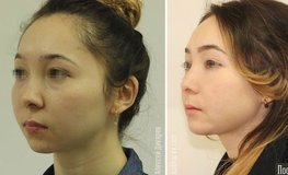 Фото до и после установки имплантов углов нижней челюсти и подбородка