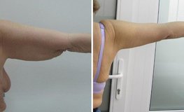 Фото до и после брахиопластики, удаления обвисших мягких тканей плеча
