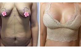 Фото до и после комплексного послеродового восстановления груди и живота