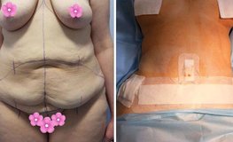 Фото до и после операции «МаммаЛифтинг»