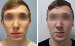 Фото до и после операции по коррекции формы ушей с двух сторон
