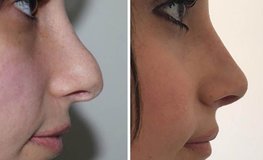 Фото до и после повторной ринопластики, подъем кончика носа