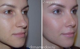 Фото до и после динамичной риноскульптуры, выравнивание спинки носа