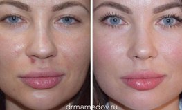 Фото до и после динамичной риноскульптуры, улучшение кончика и формы носа