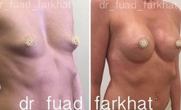 Фото до и после коррекции груди при деформации грудной клетки