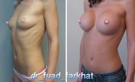 Фото до и после увеличения груди с эффектом пуш-апа