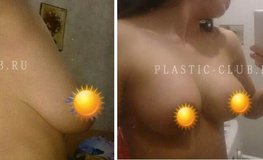 Фото до и после увеличения груди, подтяжки и уменьшения ареол