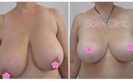 Фото до и после редукционной пластики груди с подтяжкой