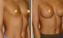 Фото до и после эндоскопического увеличения груди из подмышечного доступа