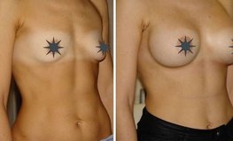 Фото до и после эндоскопического увеличения груди разрезом под мышкой