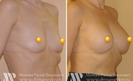 Фото до и после увеличения груди с помощью имплантатов объемом 195 мл