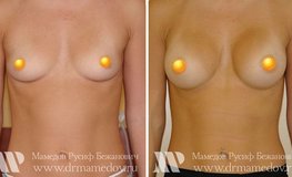 Фото до и после увеличения груди круглыми имплантатами объемом 270 мл