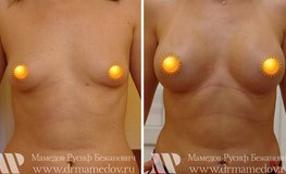 Фото до и после операции по увеличению груди анатомическими имплантатами