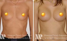 Фото до и после маммопластики (увеличение груди) круглыми имплантатами