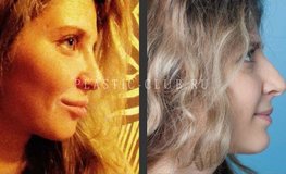 Фото до и после рино- и септопластики с ушиванием ноздрей