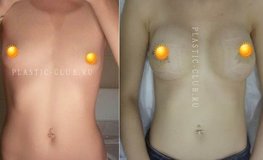 Фото до и после маммопластики по увеличению груди имплантатами объема 360 мл