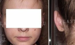 Фото до и после отопластики одного уха