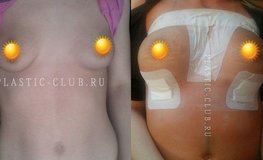 Фото до и после маммопластики имплантатами Sebbin 370 мл