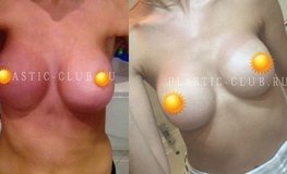 Фото после операции по увеличению груди имплантатами Natrelle mx 325 мл