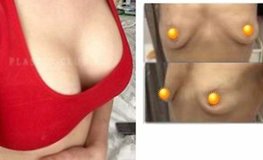 Фото до и после увеличения груди с имплантатами 370 мл