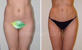 Фото до и после липоскульптуры тела и увеличения ягодиц