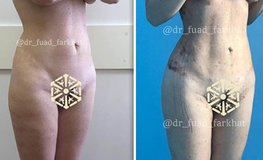 Фото до и после липоскульптурирования тела