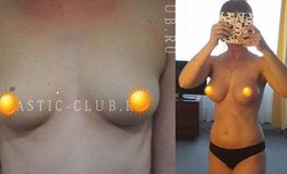 Фото до и после об установки грудных имплантатов под фасцию объемом 420 мл