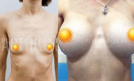 Фото до и после маммопластики имплантатами объемом 360 мл