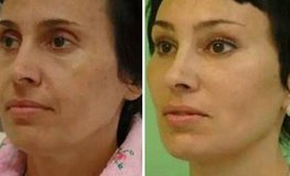 Фото до и после операции по омоложению лица и шеи по личной концепции