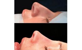 Фото до и после динамичной риноскульптуры носа закрытым доступом