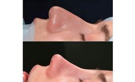 Фото до и после динамической скульптуры носа