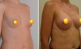 Фото до и после проведения увеличения груди имплантатами 280 сс