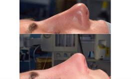 Фото до и сразу после риноскульптуры, устранение горбинки