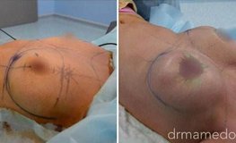 Фото до и после подтяжки и увеличения бюста имплантатами