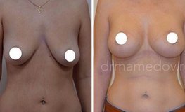 Фото до и после одномоментной подтяжки груди и установки имплантатов