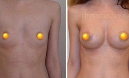 Фото до и после увеличивающей маммопластики имплантатами объема 270 мл