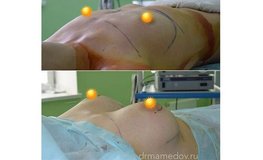 Фото до и после установки имплантатов анатомической формы объема 270 мл