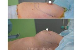 Фото до и после маммопластики анатомическими имплантатами 280 сс