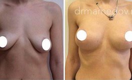 Фото до и после увеличения груди имплантатами Mentor объемом 325 мл