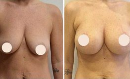 Фото до и после операции периареолярная мастопексия