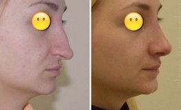 Фото до и после риносентопластики травмированного носа