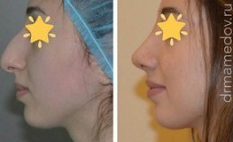 Фото до и после удаления горбинки носа и коррекция кончика