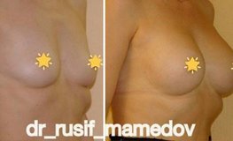 Фото до и после увеличение груди имплантатами через подмышечный доступ