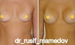 Фото до и после увеличения груди анатомическими имплантатами 280 мл