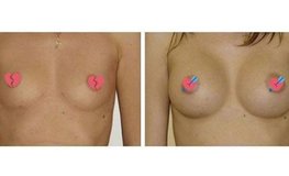 Фото до и после увеличения груди анатомическими имплантатами, объем 300 сс